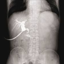 La colangiografía de rutina no está justificada