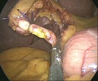 El cuidado del aislamiento es importante con los instrumentos laparoscópicos y robóticos