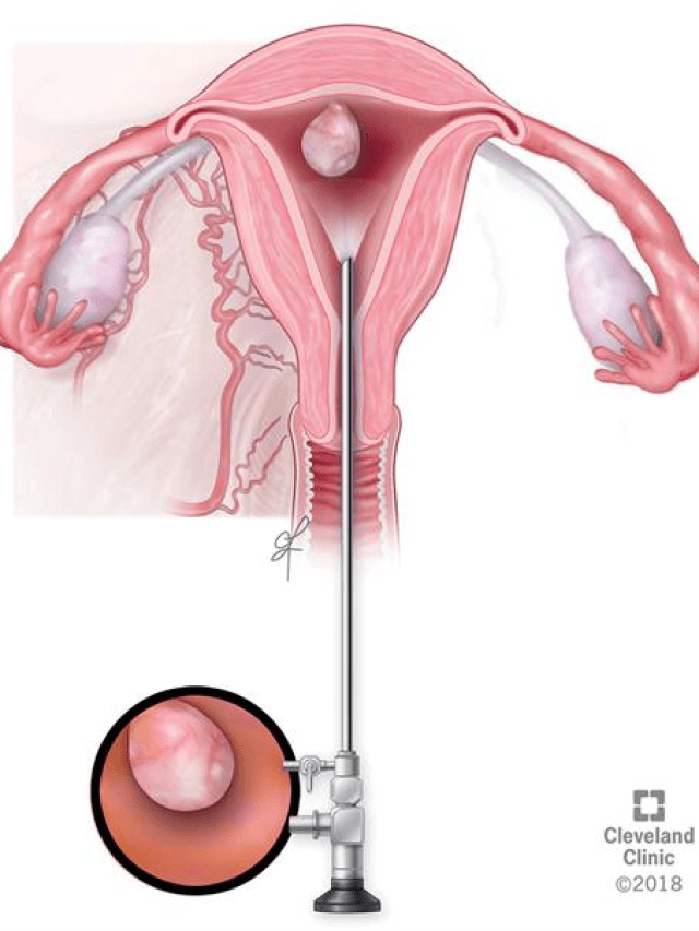 Questions about Hysteroscopy