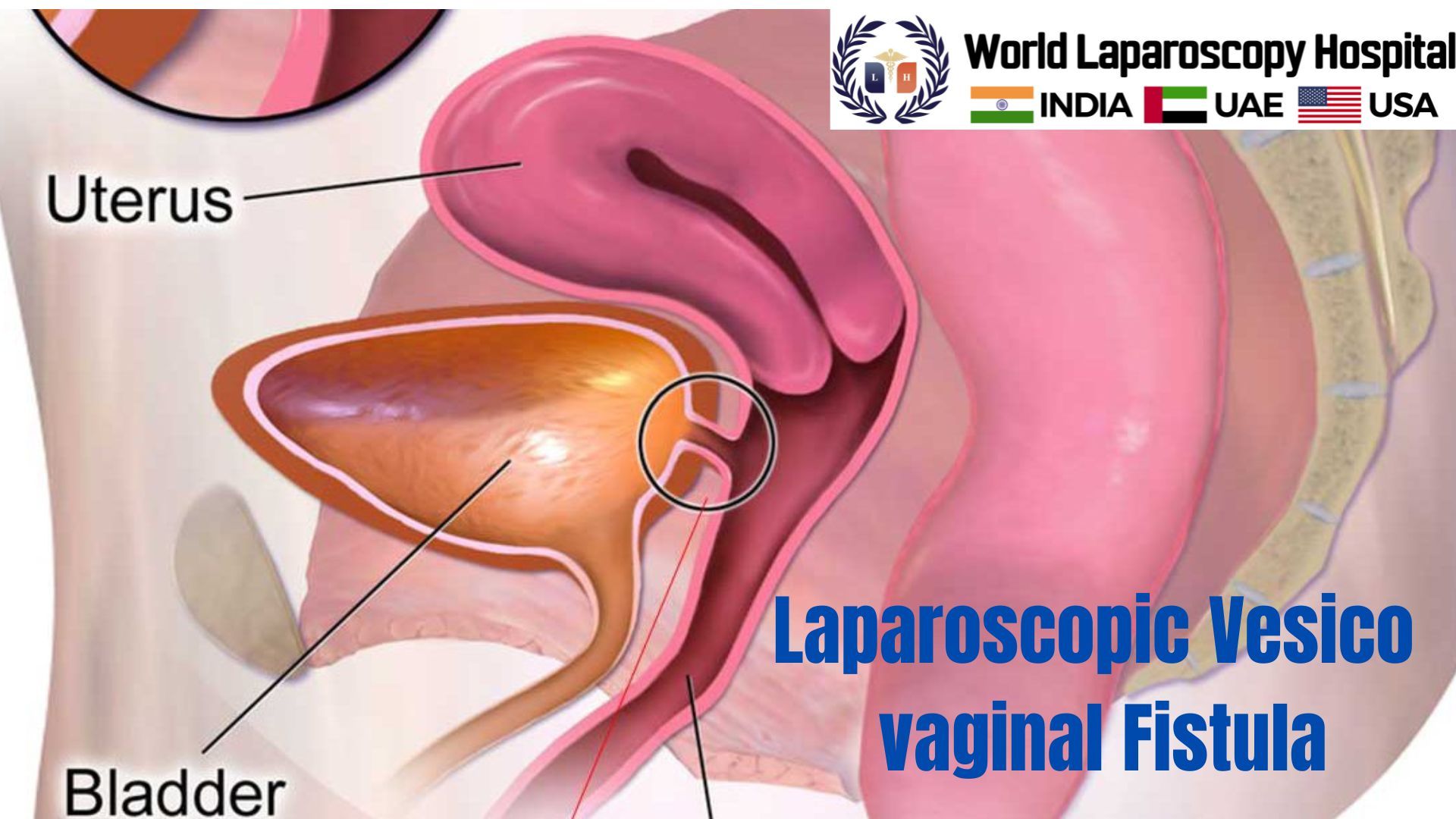 Video Lecture on Laparoscopic Vesico vaginal Fistula Repair