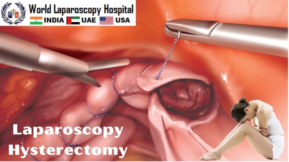 laparoscopic hysterectomy before and after