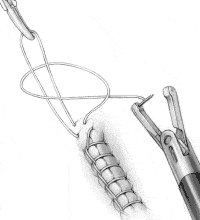 suture