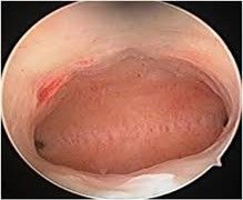 Diagnostic Hysteroscopy