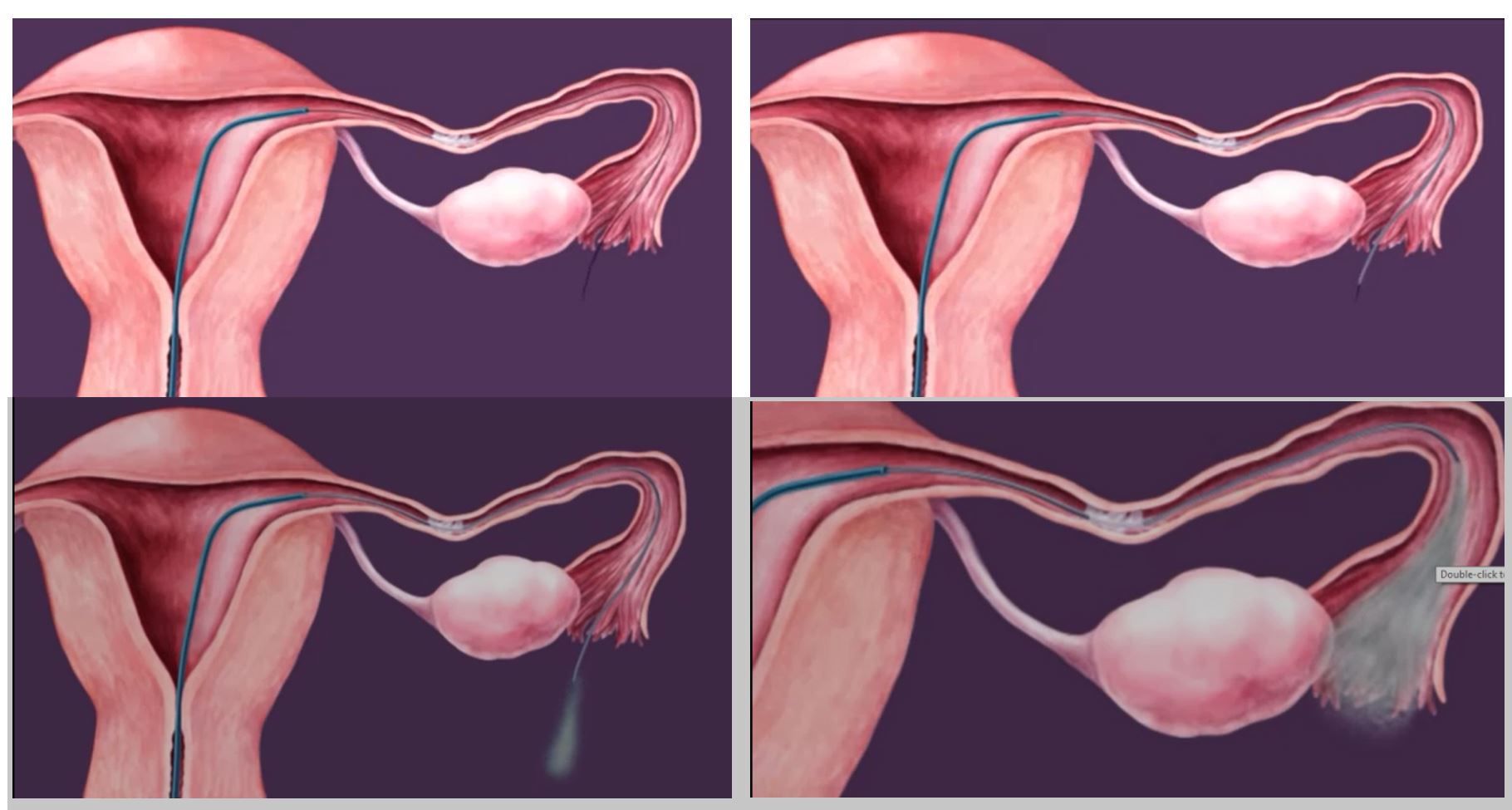 Cannulation of the Fallopian Tube