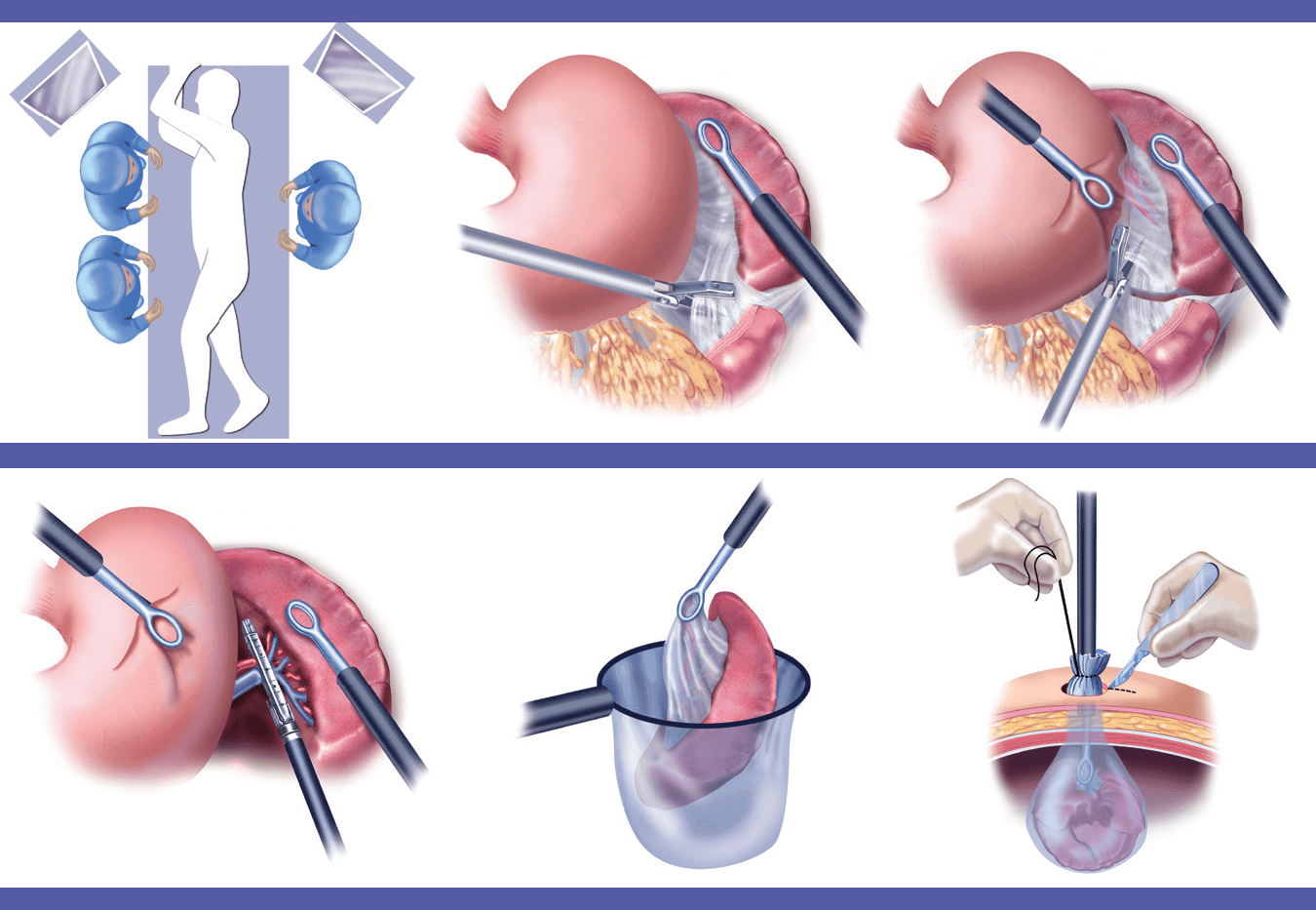 Laparoscopic Splenectomy