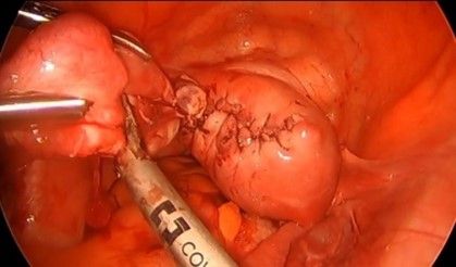 BASEBALL SUTURING TO BE DONE ALONG WITH SALPINGECTOMY