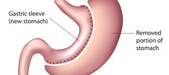 Laparoscopic Sleeve Gastrectomy