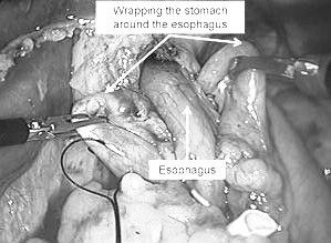 Fundoplication Fixation of Wrap