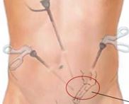 Port Position of Hernia