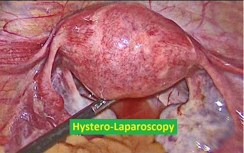 Hystero-Laparoscopy