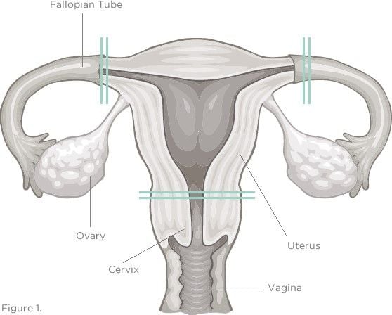 Laparoscopic Hysterectomy