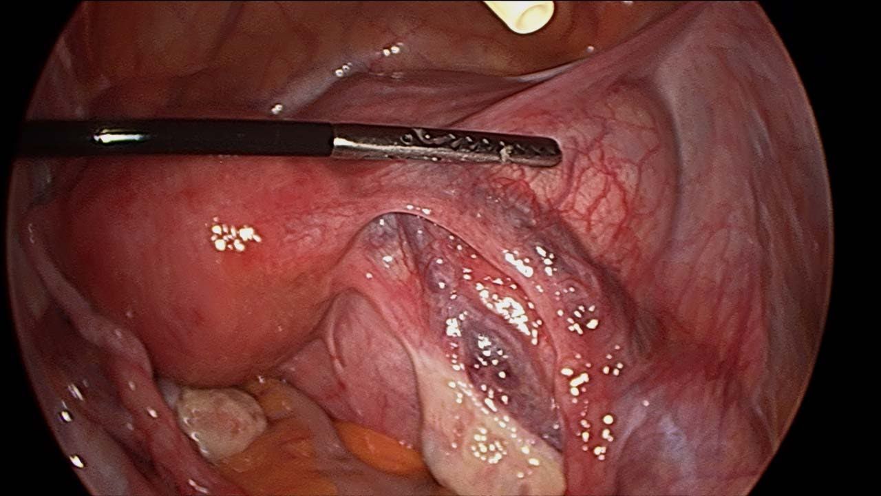 Laparoscopic Salpingotomy