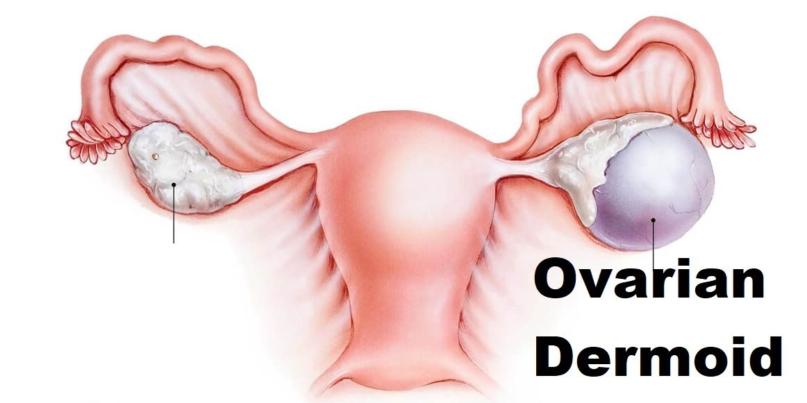 Ovarian Dermoid Cyst