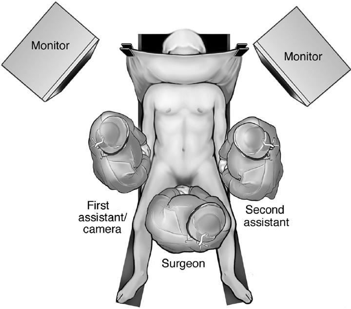 Position of Surgical Team for Sleeve Gastrectomy