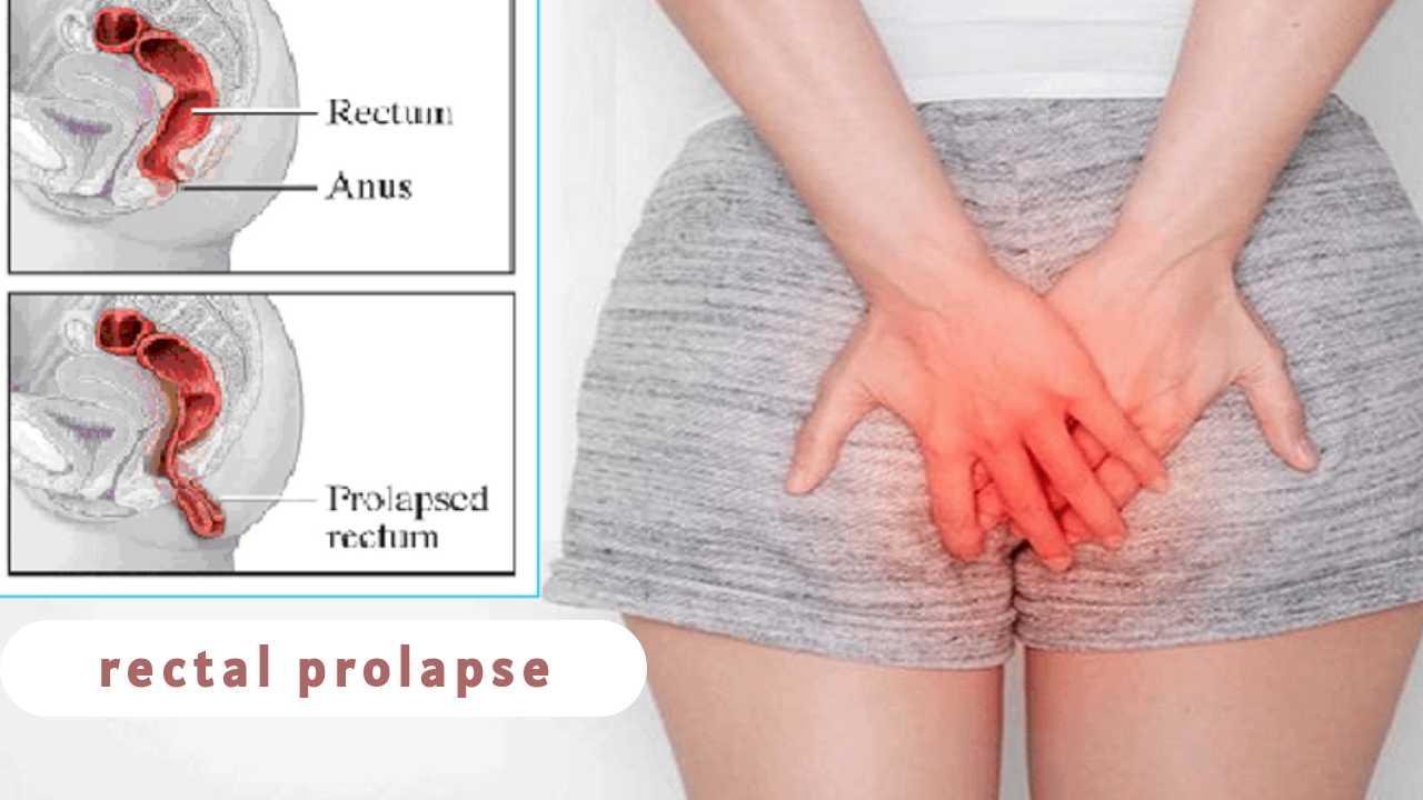 Laparoscopic Management of Rectal Prolapse