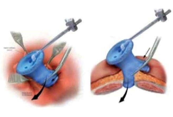 Single Incision Laparoscopic Surgery