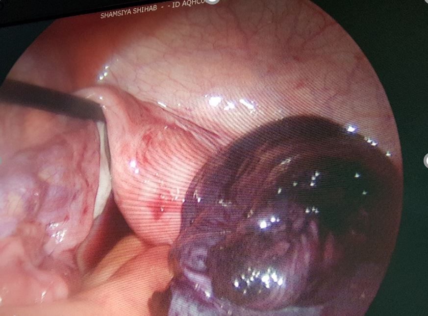 Ovarian Cystectomy