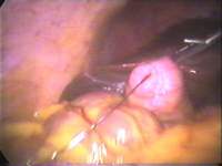 two ports Cholecystectomy