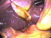 two ports Cholecystectomy