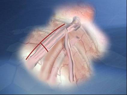 Laparoscopic Vricocelectomy