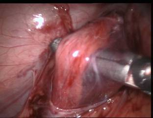 Laparoscopic Vricocelectomy