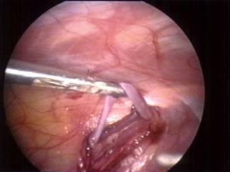 Laparoscopic Vricocelectomy