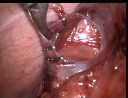 Clips applied around spermatic vein