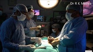 Laparoscopic Varicocelectomy