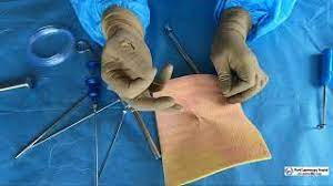 Laparoscopic Port Closure or Fascial Closure Needles