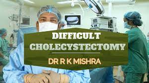 Mishra Knot for Cystic Duct in Acute Cholecystitis