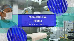 Para-umbilical Hernia IPOM Repair