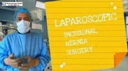 Laparoscopic Incisional Hernia Repair by IPOM Plus Technique and Titanized Mesh