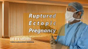 Ruptured Ectopic Pregnancy