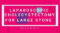 Difficult Laparoscopic Cholecystectomy for Large Gallbladder Stone for Chronic Cholecystitis