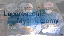 Laparoscopic Myomectomy Step by Step Video