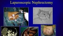 Laparoscopic Myomectomy for Large Myoma by Dr. R.K. Mishra