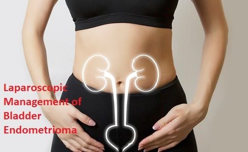 गर्भाशय की रसौली, बच्चेदानी में गांठ होने के लक्षण, कारण, इलाज व बचाव