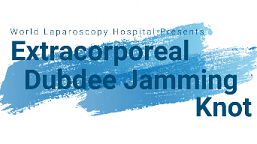 Laparoscopic Management of Retrocecal Subserous Ruptured Appendix