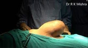 Laparoscopic Repair of Huge Incisional Hernia