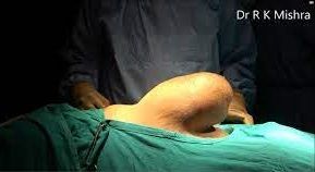Laparoscopic Repair of Huge Incisional Hernia