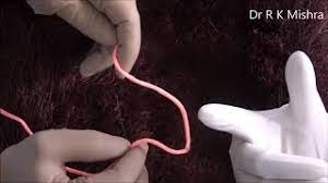 Mishra's Knot - Ideal for Laparoscopic Cholecystectomy