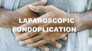 Laparoscopic Nissen fundoplication - Dr R K Mishra
