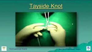 Mastering the Laparoscopic Roeder's Knot