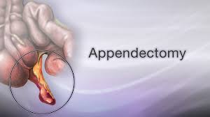 How to Perform Safe Laparoscopic Appendectomy - Lecture by Dr R K Mishra