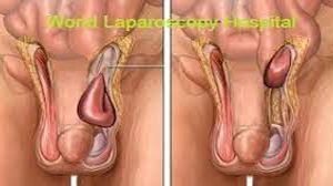 Laparoscopic inguinal hernia repair "IPOM" with Dual-Mesh