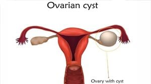 Torted Ovarian Dermoid Cyst in 7 Year Old Girl