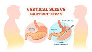 Obesity Surgery - Vertical Sleeve Gastrectomy