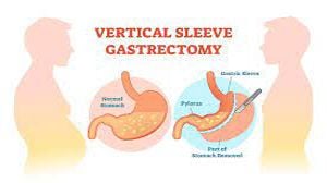 Laparoscopy Mastery: Filling the Gaps in My General Surgery Knowledge Through Training