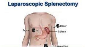 Laparoscopic Salpingotomy for Ectopic Pregnancy