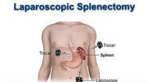 Splenectomy